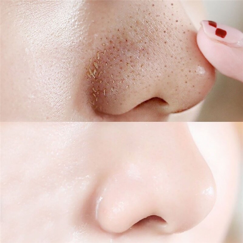 Blackhead Remover - MONLANE